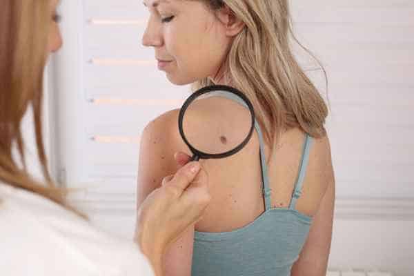 What Are Traditional Skin Lesion Removal Methods Daventry?