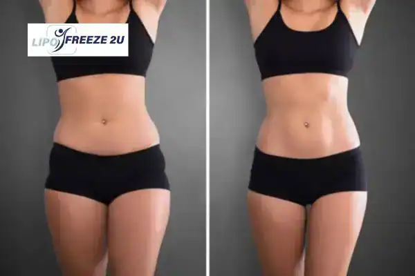 How Can LIPO FREEZE 2U Support Your Post-Pregnancy Body Recovery Daventry?