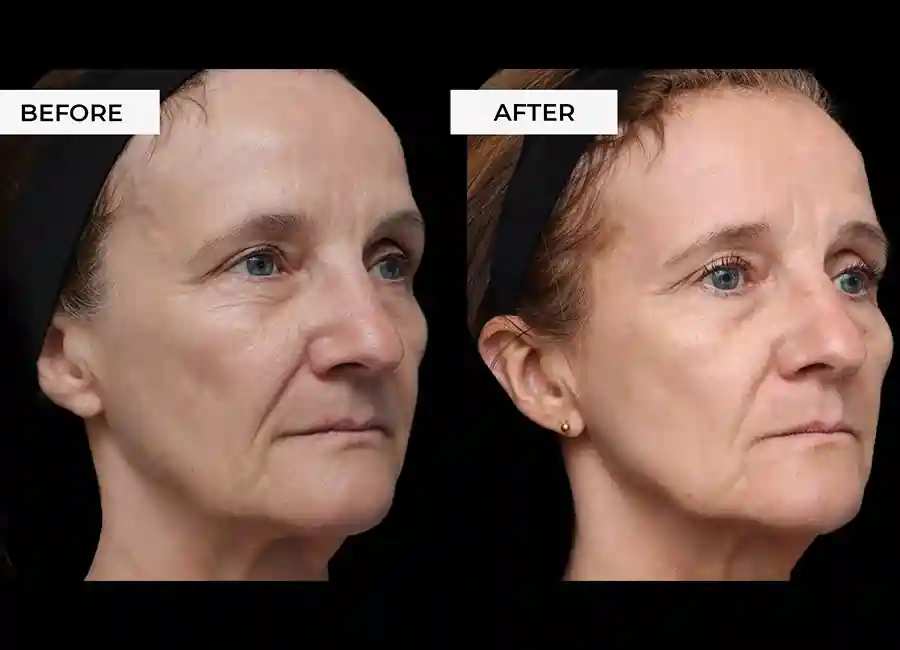 How Many RF Microneedling Sessions Will You Need to See a Difference Daventry?