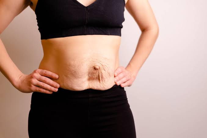 Is Surgery Really the Only Way to Repair Diastasis Recti Daventry?