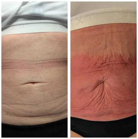 How Does RF Microneedling Improve Crepey, Thin and Uneven Skin Texture Daventry?