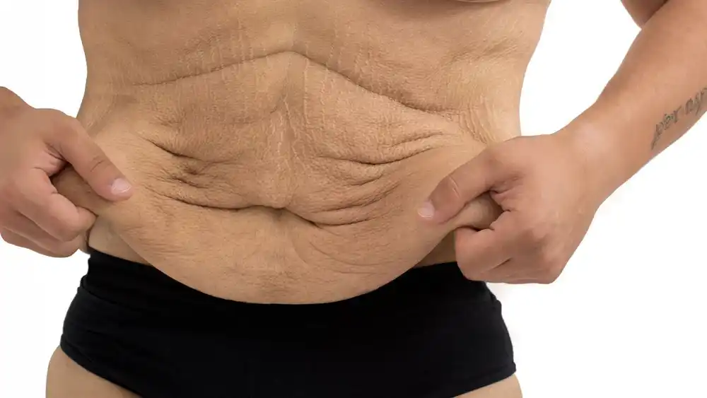 RF Microneedling for Loose Skin: How Can It Help Tighten and Reshape the Skin Daventry?